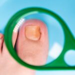 Cómo prevenir y tratar la aparición de uñas encarnadas en forma natural