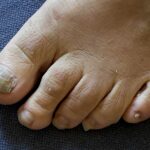 Consejos para evitar los hongos en las uñas